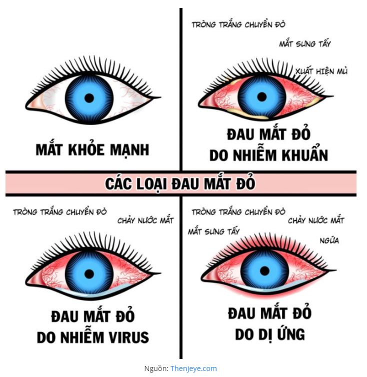 Đau mắt đỏ là một bệnh lý phổ biến về mắt có thể mắc phải ở mọi lứa tuổi. Bệnh gây ra các triệu chứng như đỏ mắt, ngứa mắt, chảy nước mắt, sưng mi mắt,... Đau mắt đỏ có thể do nhiều nguyên nhân gây ra, bao gồm nhiễm virus ( chiếm khoảng 80% các trường hợp), vi khuẩn, hoặc dị ứng.